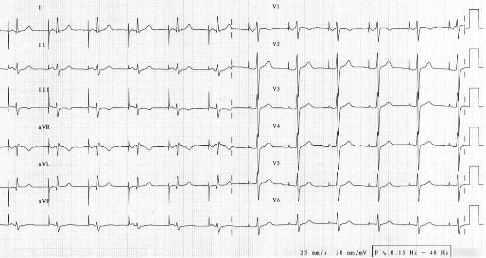 EKG kardiostimulátor.jpg