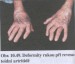 Deformity rukou.jpg